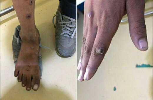 کدام افراد به آبله میمون مبتلا میشوند؟